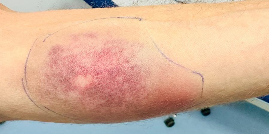 Journée mondiale du sepsis, « le grand méconnu »